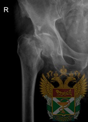 Рентген - перелом шейки бедра